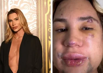 Fox eyes: entenda procedimento que vitimou influenciador digital