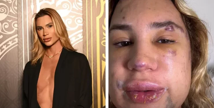 Fox eyes: entenda procedimento que vitimou influenciador digital